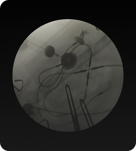 인공요관우회술 SUB